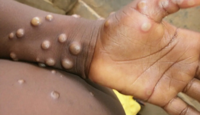 Monkey Pox